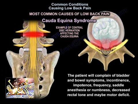 Common Causes of Low Back Pain – Everything You Need To Know – Dr. Nabil Ebraheim